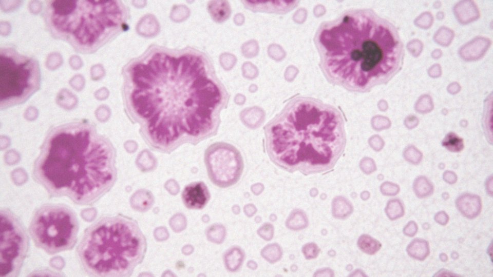 Jakie role odgrywa zakażenie Helicobacter pylori w metaplazji jelitowej?
